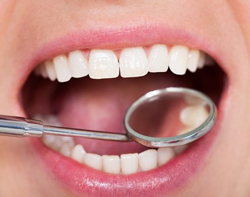 Teeth examined with dental mirror